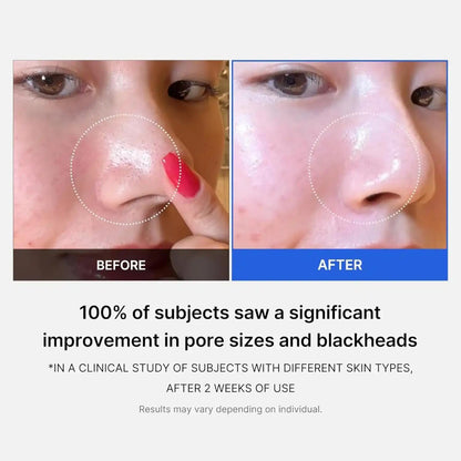 Before and after comparison of a nose with pore size and blackhead reduction, showing a clinical study result.