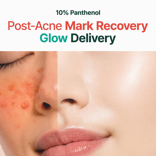 Before and after comparison of a face with acne marks and smooth skin, labeled '10% Panthenol Post-Acne Mark Recovery Glow Delivery'.
