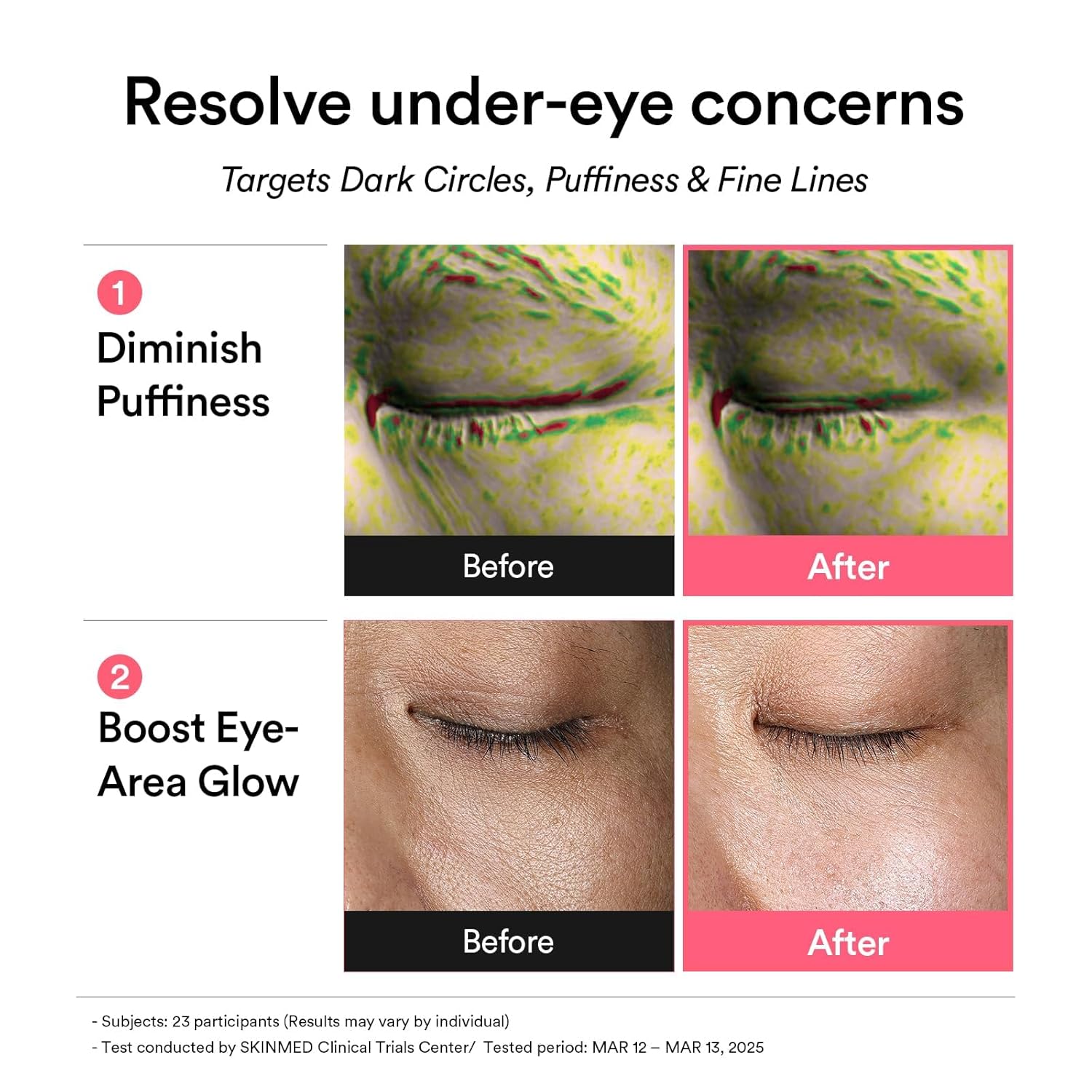 Before and after effects of eye cream on dark circles, puffiness, and fine lines.