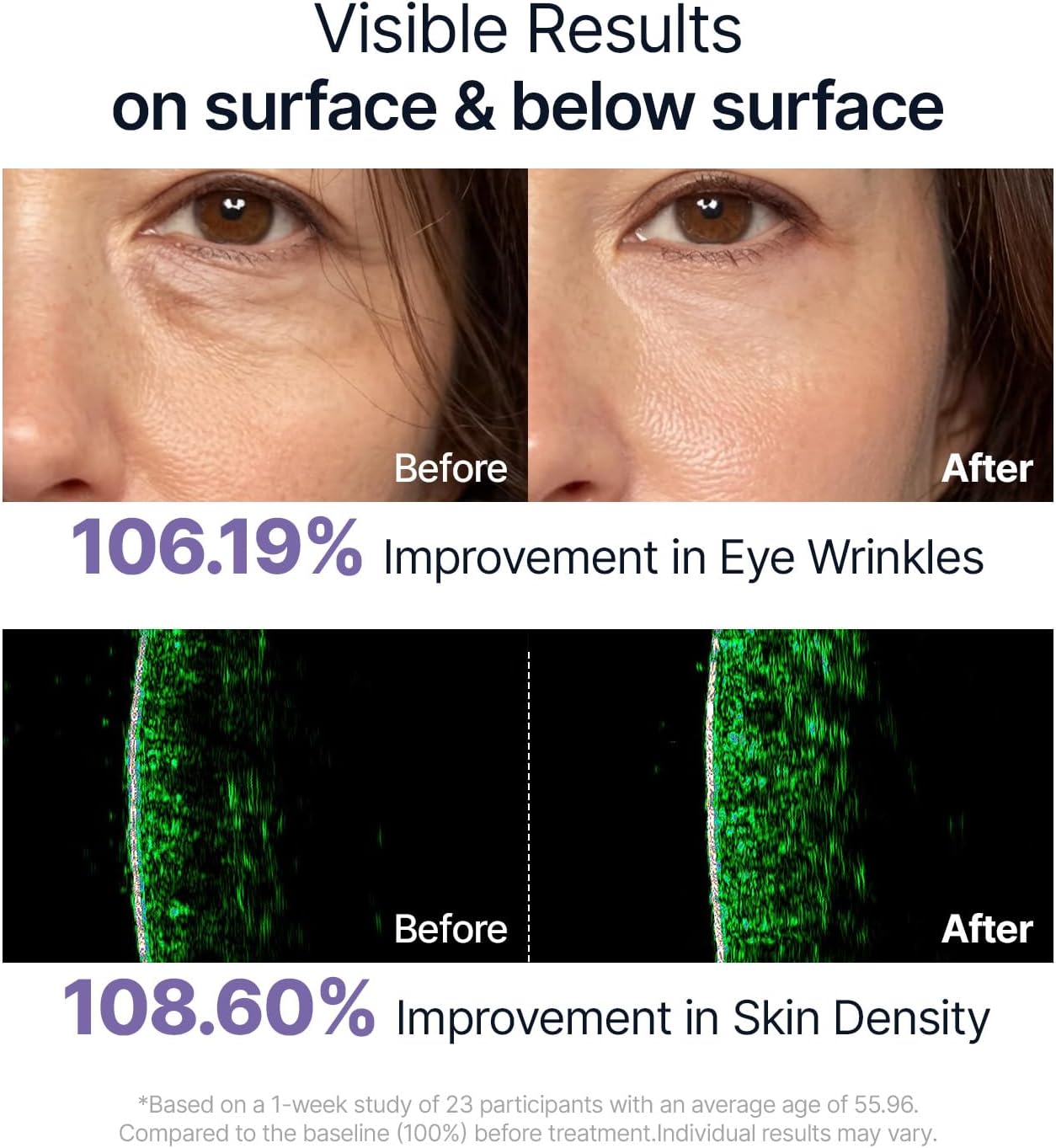 Before and after effects of a skincare treatment on eye wrinkles and skin density.