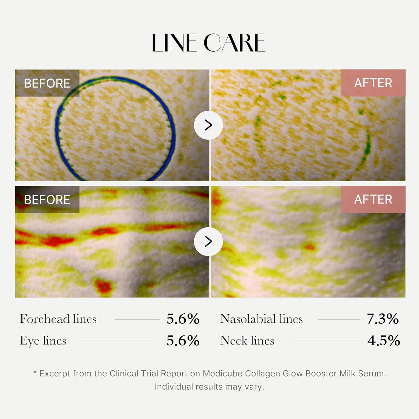 Before and after line care treatment images with statistical data on line reduction.