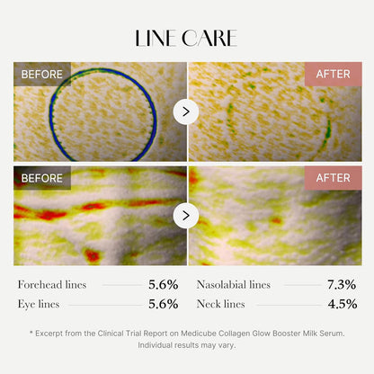 Before and after line care treatment images with statistical data on line reduction.