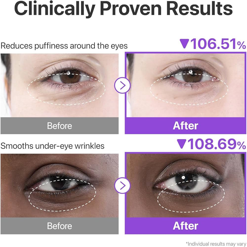 Before and after effects of eye cream on puffiness and wrinkles with clinical data.