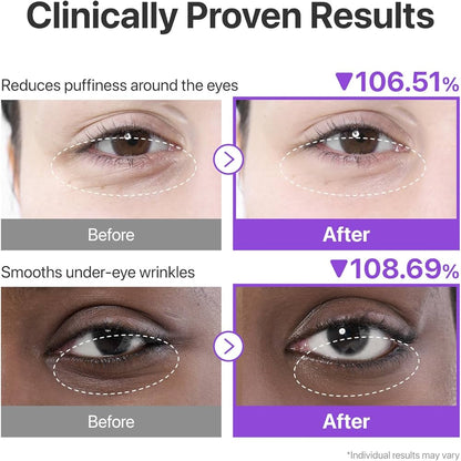 Before and after effects of eye cream on puffiness and wrinkles with clinical data.
