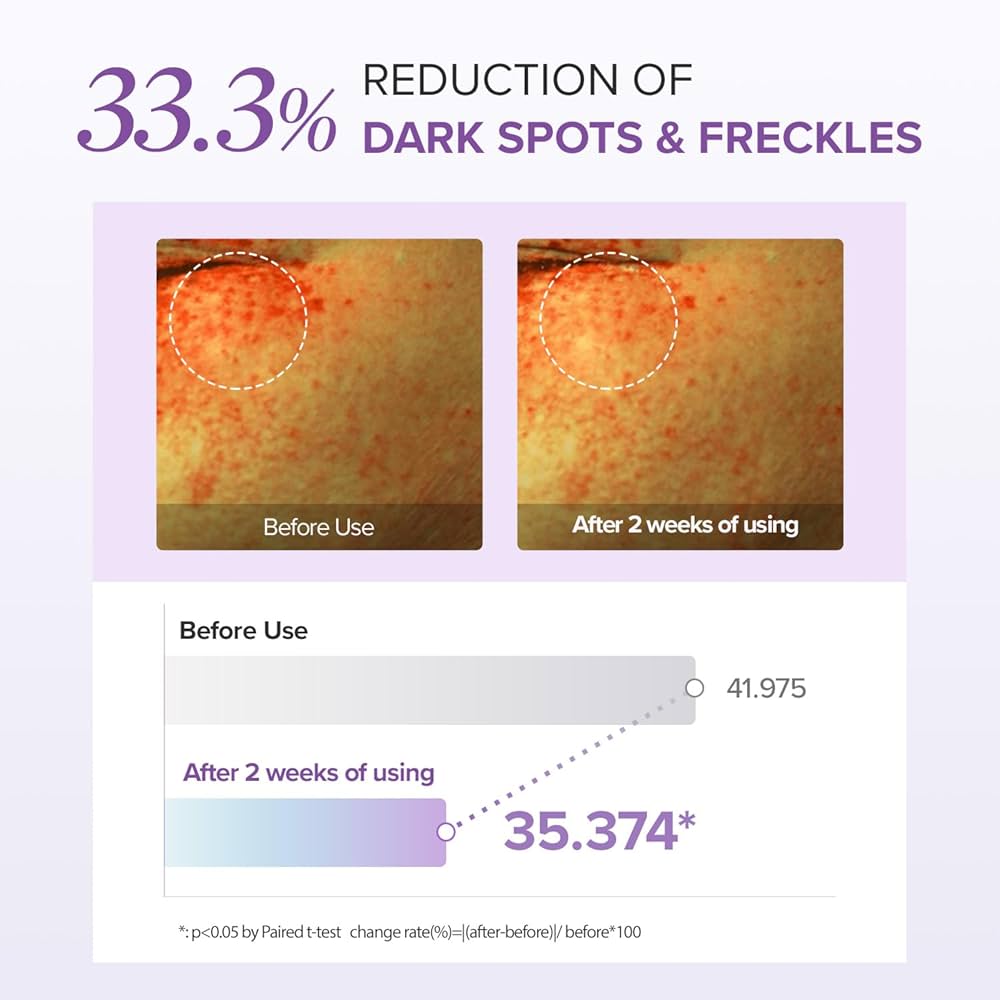 Before and after comparison of dark spots and freckles with a 33.3% reduction shown on a purple background.