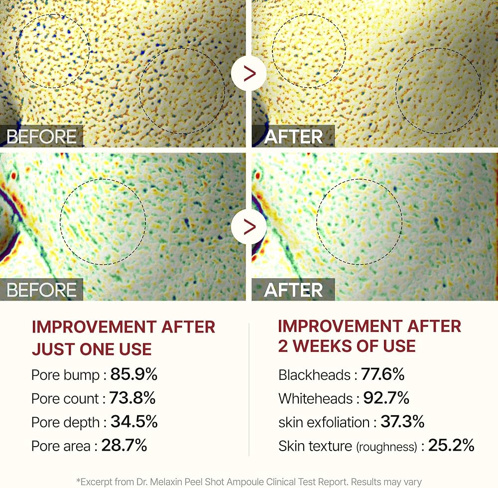 Before and after comparison of skin treatment with improvement statistics.